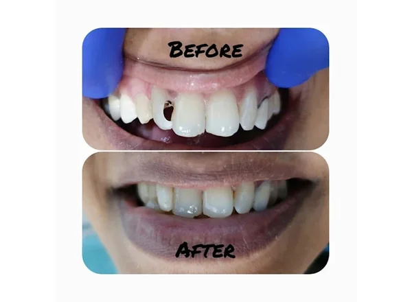 Before and After
