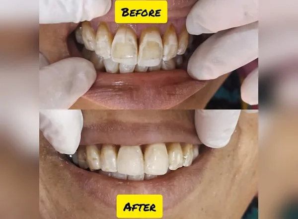 Before and After