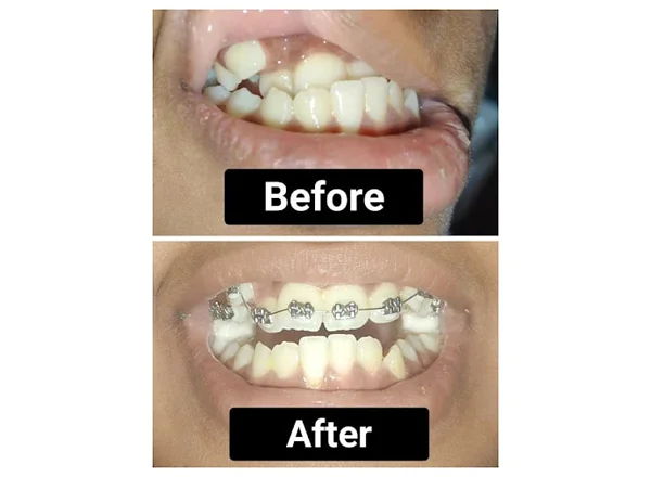 Before and After