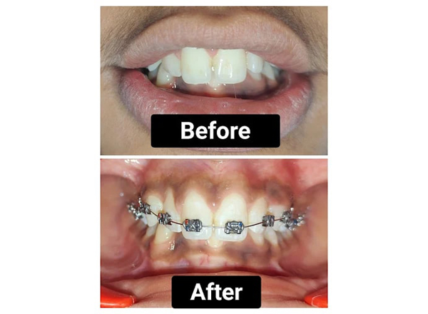 Before and After