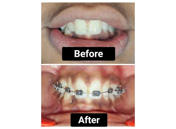 Before and After