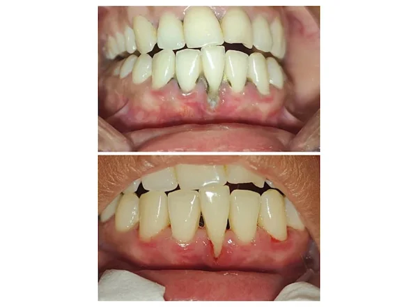 Before and After