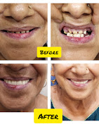 Before and After