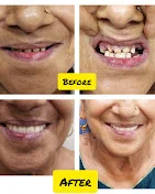 Before and After