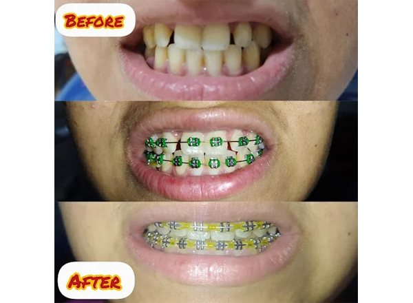 Before and After