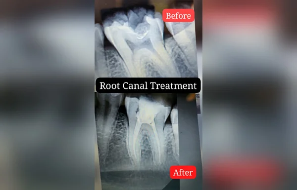 Root Canal Treatment