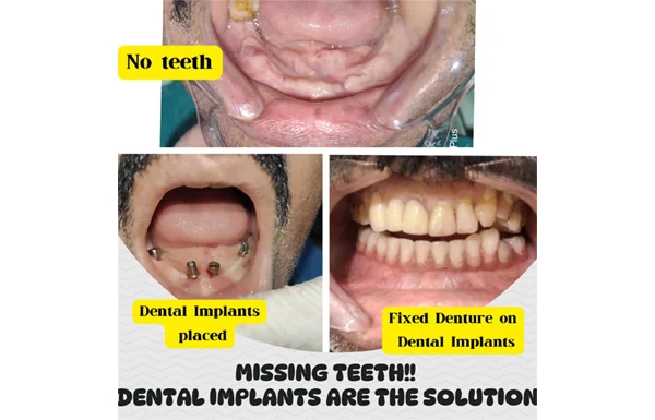 Dental Implants