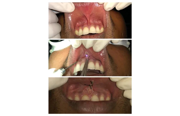 Gum Surgeries