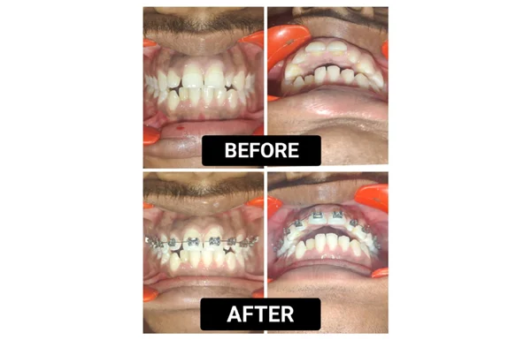 Orthdontic Treatment
